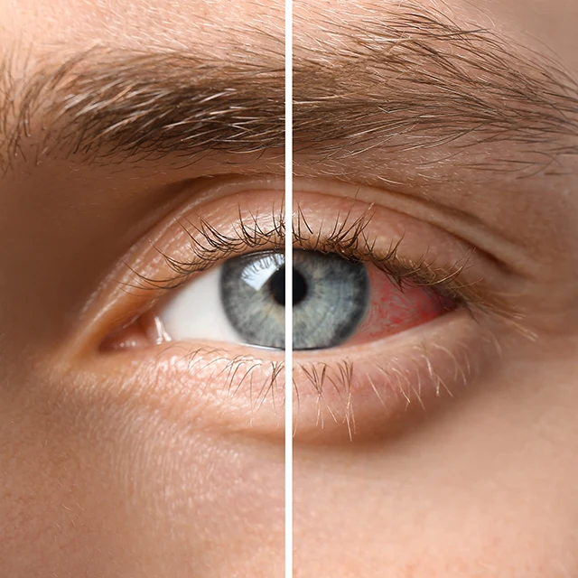 Augen lasern Risiken