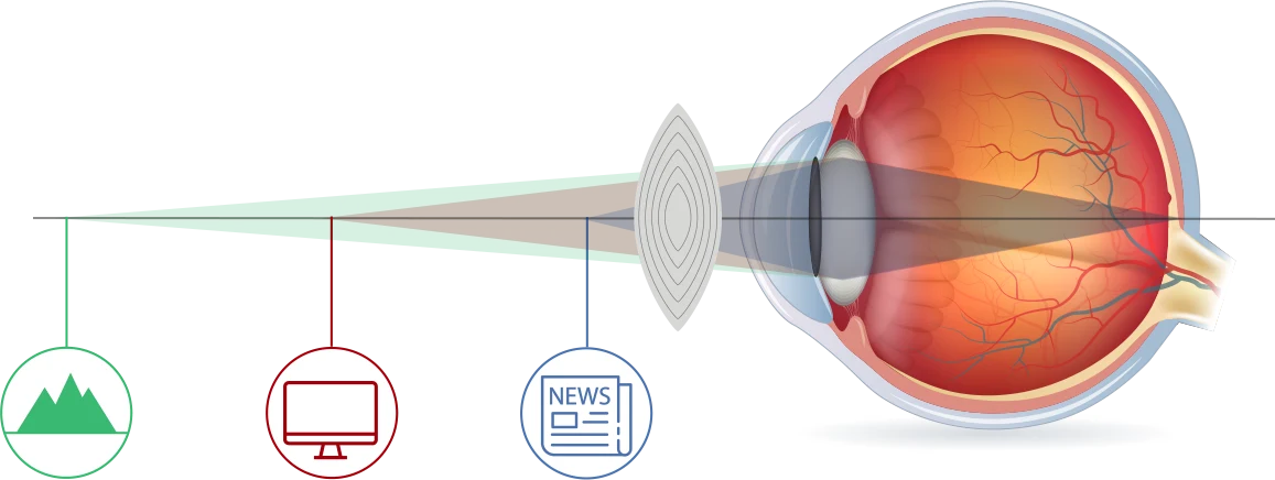 augen lasern über 60