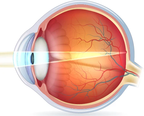 alterssichtiges-auge-lichteinfall-korrigiert Kurzsichtigkeit: anatomische Ursachen der Myopie