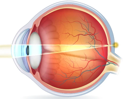 alterssichtiges-auge-lichteinfall Kurzsichtigkeit: anatomische Ursachen der Myopie