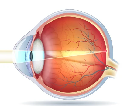 hornhautverkruemmtes-auge-lichteinfall-korrigiert Hornhautverkrümmung: anatomische Ursachen des Astigmatismus