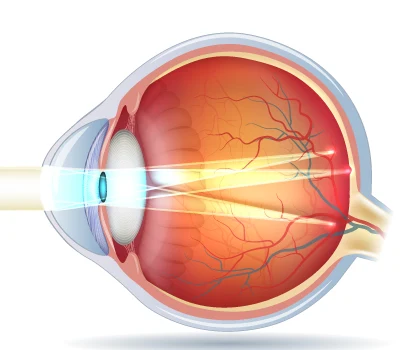 hornhautverkruemmtes-auge-lichteinfall Hornhautverkrümmung: anatomische Ursachen des Astigmatismus
