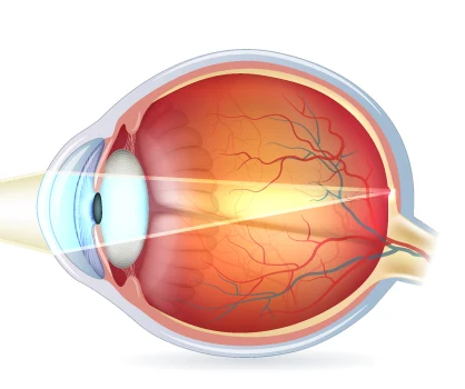 kurzsichtiges-auge-lichteinfall-korrigert Kurzsichtigkeit: anatomische Ursachen der Myopie