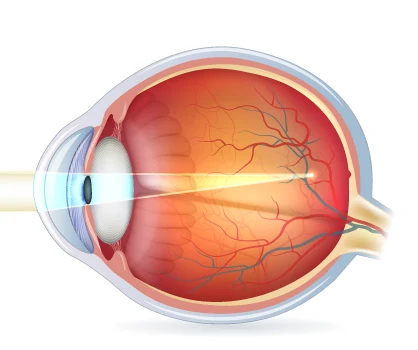 kurzsichtiges-auge-lichteinfall Kurzsichtigkeit: anatomische Ursachen der Myopie