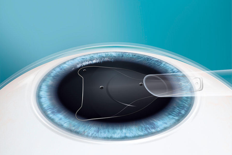 Lasermed Evo Visian ICL: Platzierung der Linse