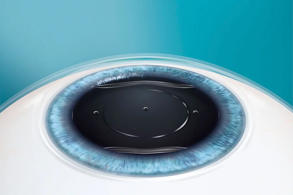 Lasermed Evo Visian ICL: Sitz der Linse im Auge Lasermed Evo Visian ICL: Sitz der Linse im Auge