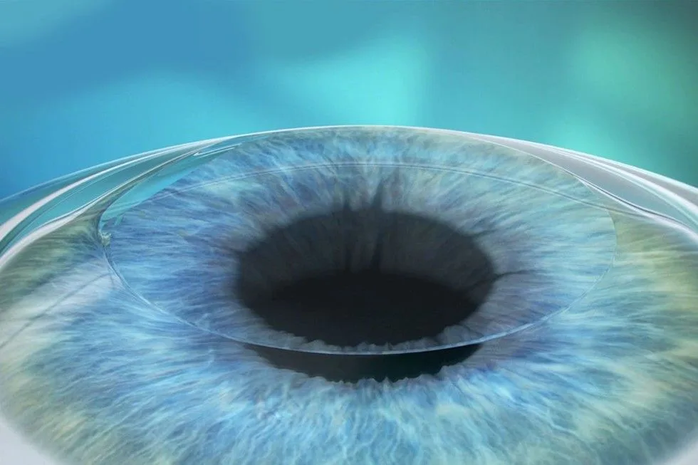 Lasermed Augenlasern Flap anlegen