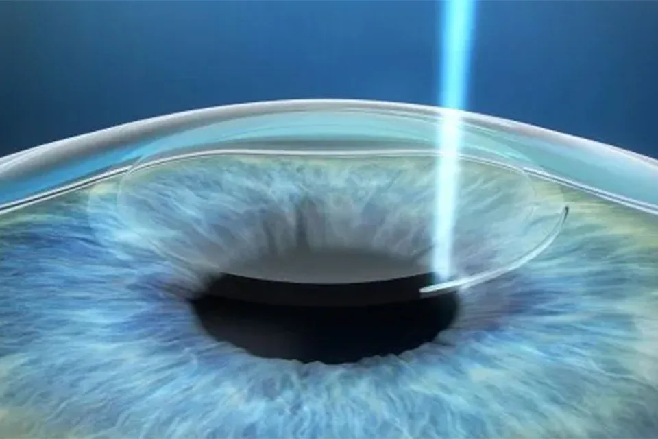 Lasermed Relex Smile: Präparation des Lentikels