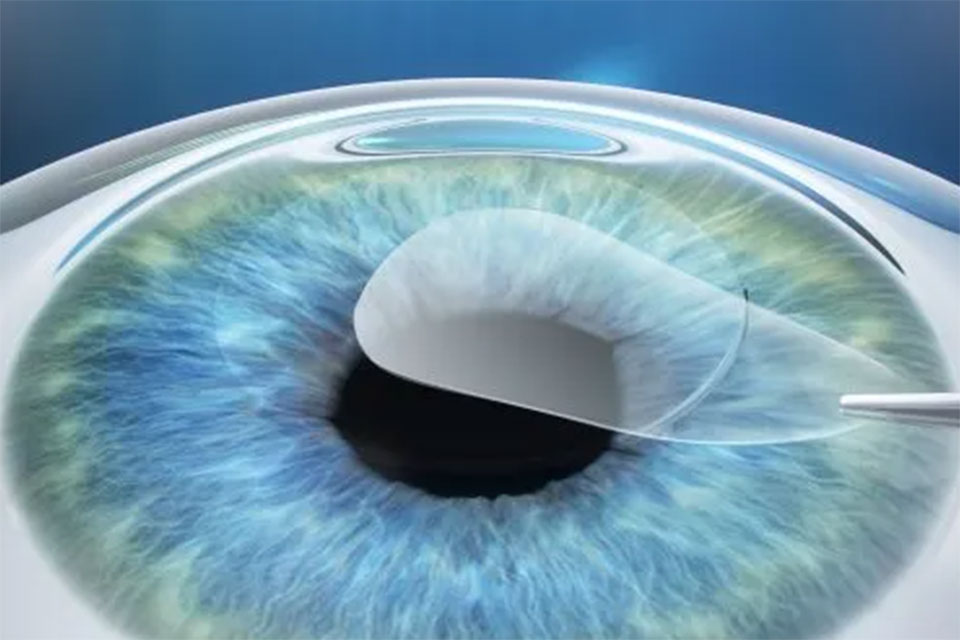 Lasermed Relex Smile: Entnahme des Lentikels Lasermed Relex Smile: Entnahme des Lentikels