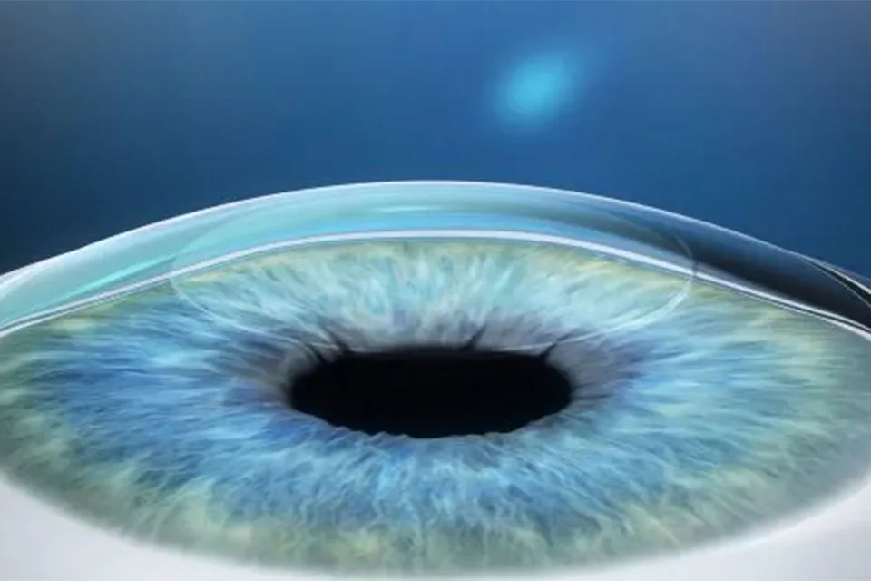 Lasermed Relex Smile: Rehabilitation