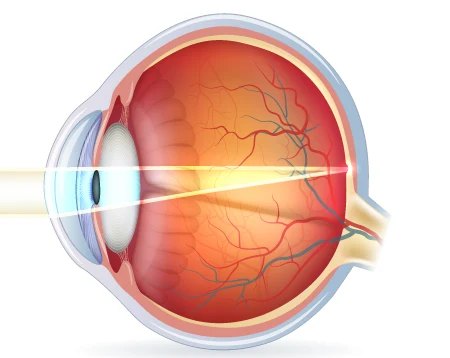 weitsichtiges-auge-lichteinfall-korrigiert Weitsichtigkeit: anatomische Ursachen der Hyperopie