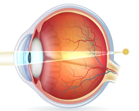 weitsichtiges-auge-lichteinfall Weitsichtigkeit: anatomische Ursachen der Hyperopie