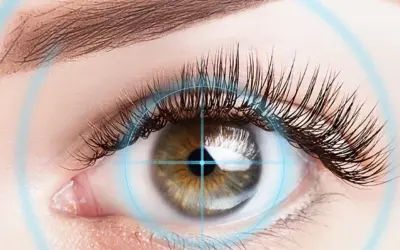 Femtosekundenlaser: Vorgehen bei der klassischen LASIK