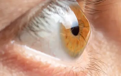 Kann man Keratokonus mit Laser behandeln? 