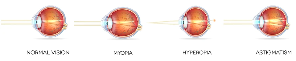 hornhautdicke augenlasern