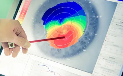 Wellenfront-LASIK: Aberrometrie einfach erklärt