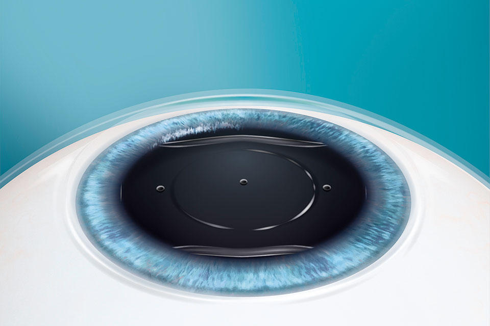 Lasermed Evo Visian ICL: Sitz der Linse im Auge
