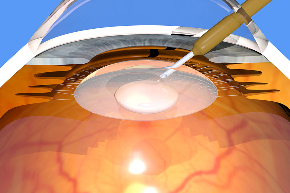 Lasermed Multifokallinse: Linse zerkleinern und absaugen