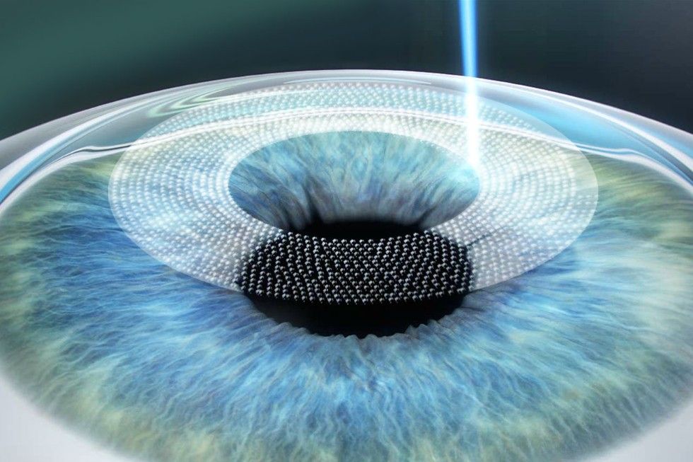 Lasermed Augenlasern Flap erzeugen